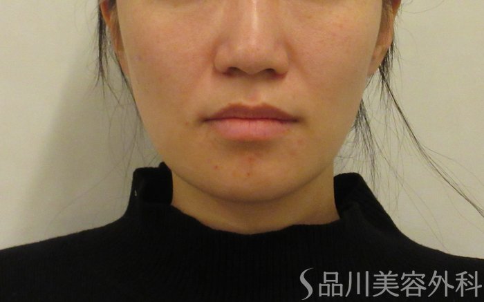 症例NO.72989のBEFORE写真