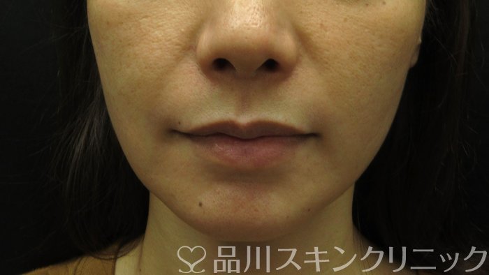 症例NO.70504のBEFORE写真