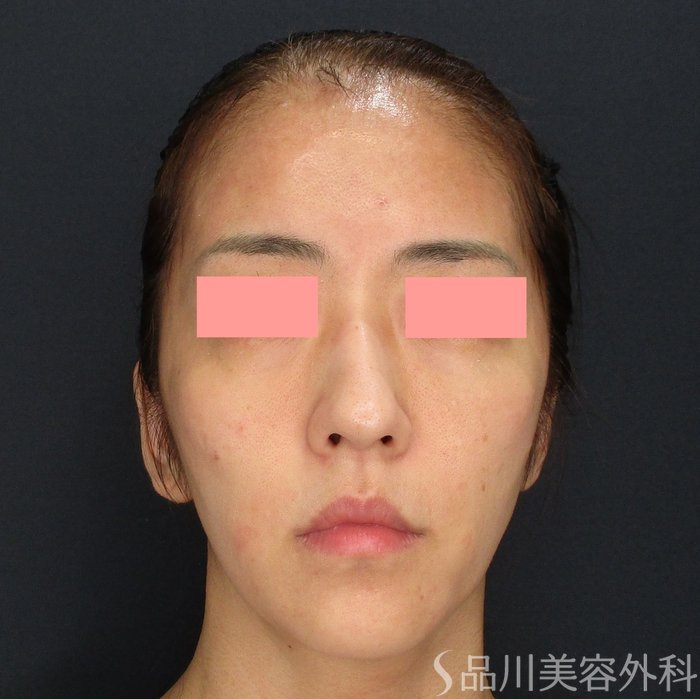 症例NO.71445のBEFORE写真