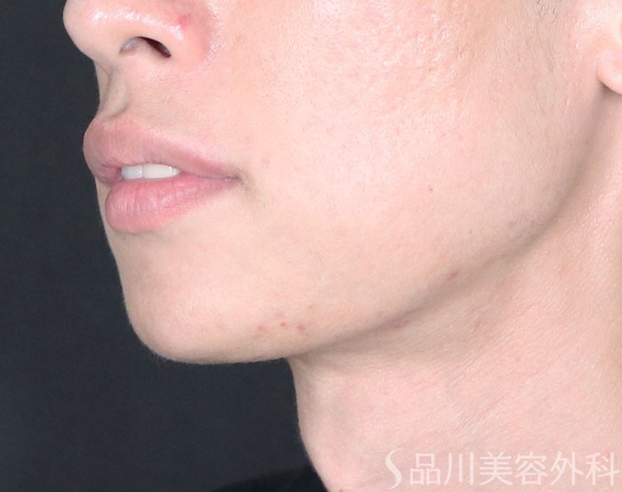 症例NO.73972のBEFORE写真