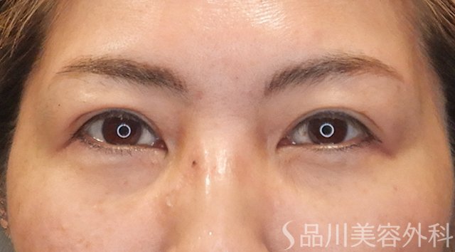 症例NO.75297のBEFORE写真