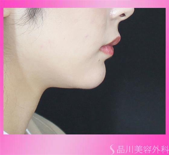 症例NO.57154のAFTER写真