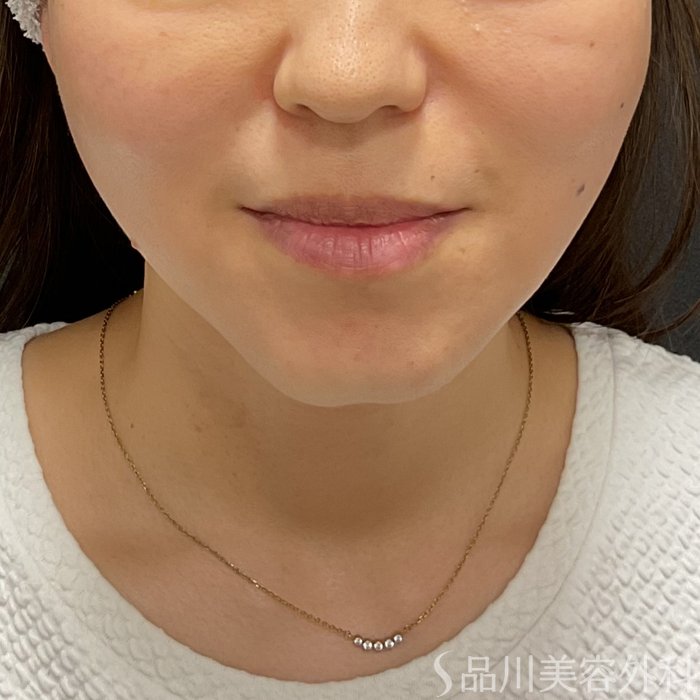 症例NO.75293のAFTER写真