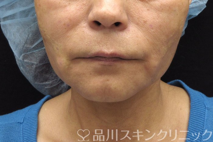 症例NO.74388のAFTER写真
