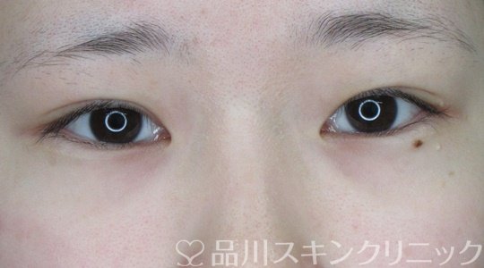 症例NO.69990のBEFORE写真