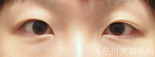 症例NO.70997のBEFORE写真