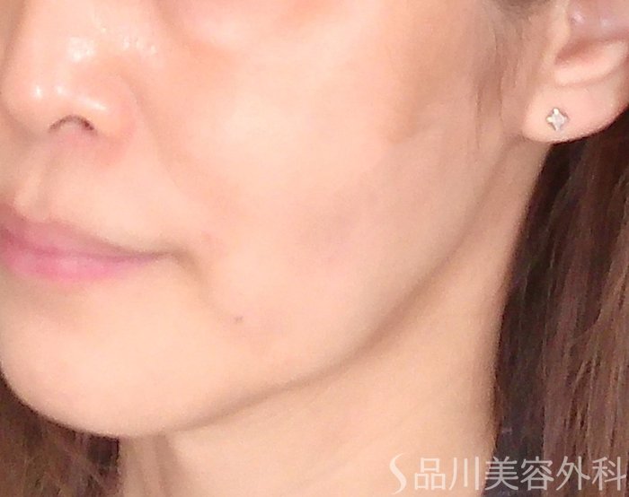 症例NO.70045のAFTER写真