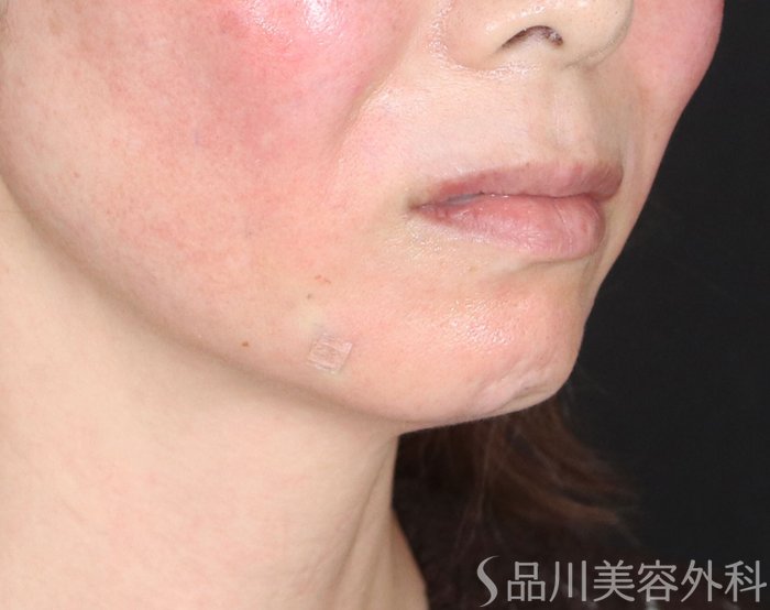 症例NO.72372のAFTER写真