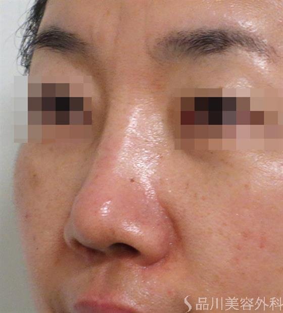 症例NO.36508のAFTER写真