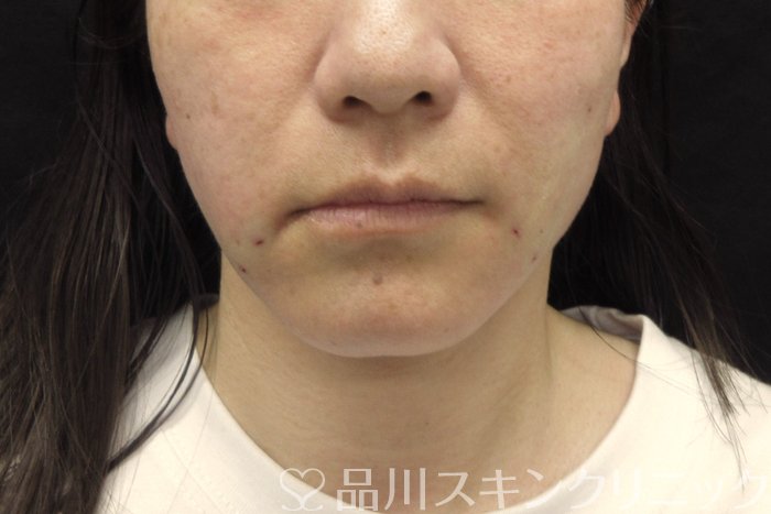 症例NO.74816のAFTER写真