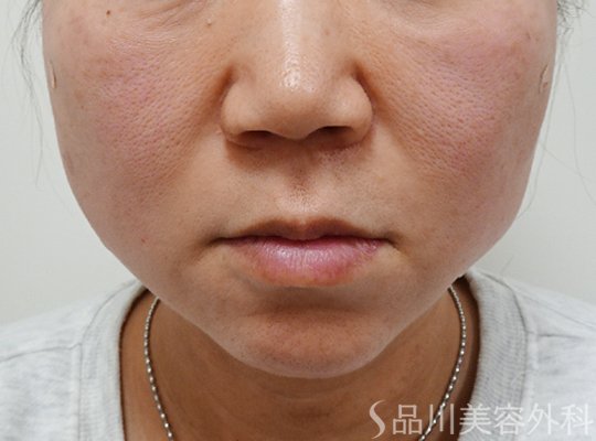 症例NO.73437のAFTER写真