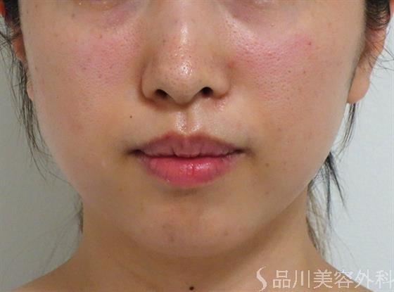 症例NO.39685のAFTER写真