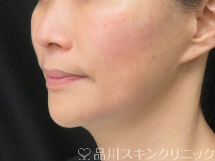 症例NO.69947のAFTER写真