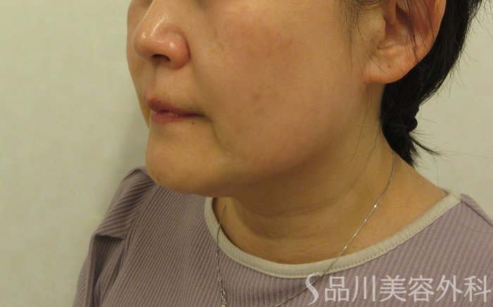 症例NO.72342のBEFORE写真