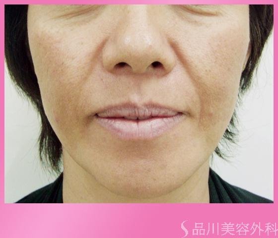 症例NO.1152のBEFORE写真