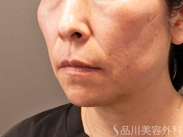 症例NO.70858のBEFORE写真