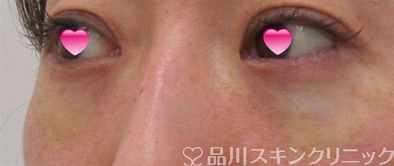症例NO.40815のAFTER写真
