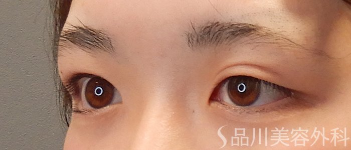 症例NO.69305のBEFORE写真