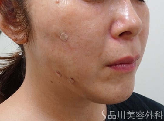 症例NO.72567のAFTER写真