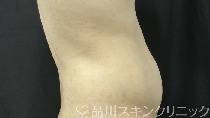 症例NO.71099のBEFORE写真