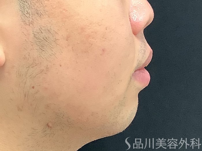 症例NO.67909のBEFORE写真