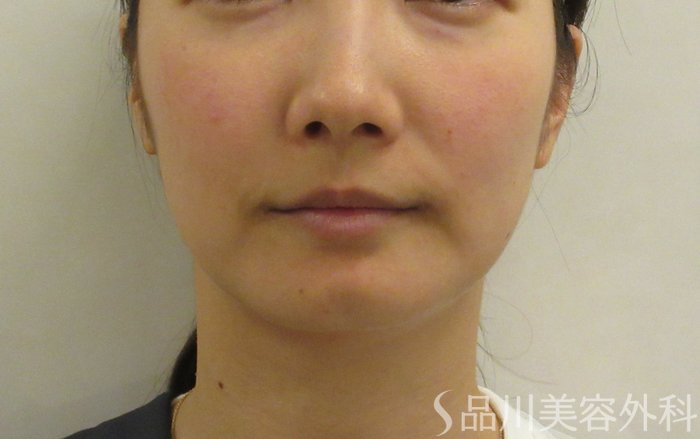 症例NO.71334のBEFORE写真