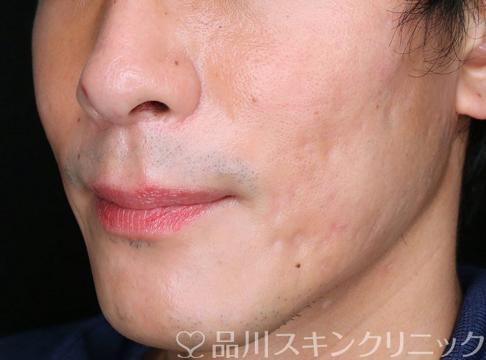 症例NO.72555のAFTER写真