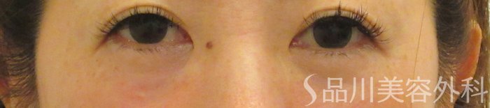 症例NO.73337のAFTER写真