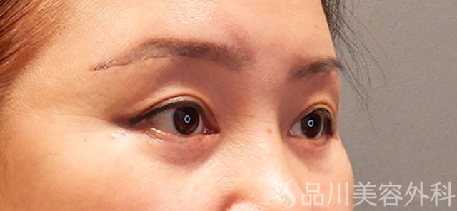 症例NO.70675のAFTER写真