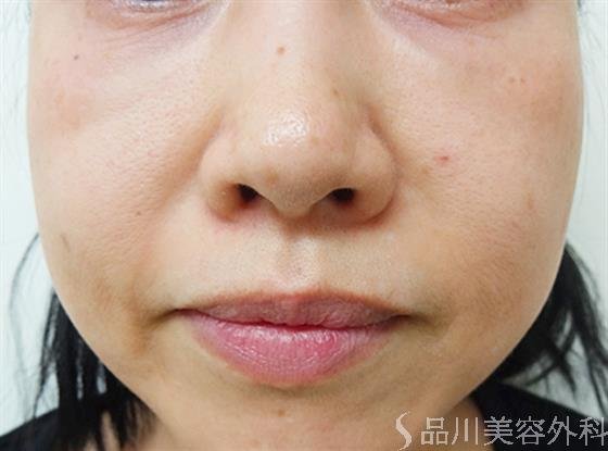 症例NO.24851のAFTER写真