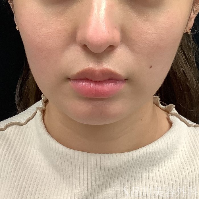 症例NO.75326のBEFORE写真