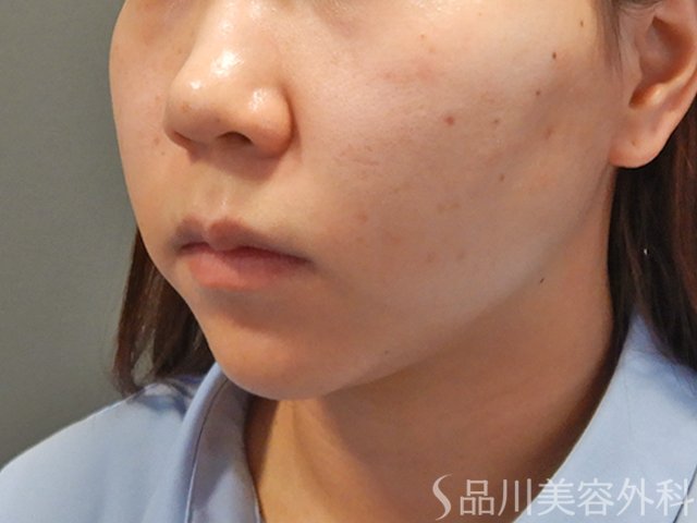 症例NO.74288のBEFORE写真