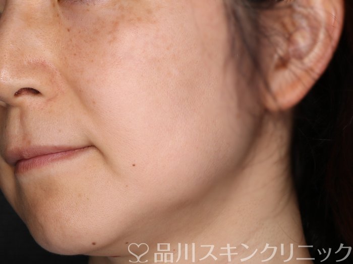 症例NO.71346のAFTER写真