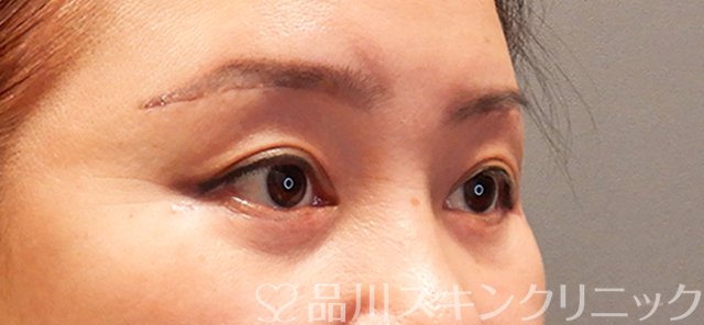 症例NO.70675のAFTER写真