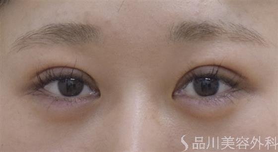 症例NO.52692のAFTER写真
