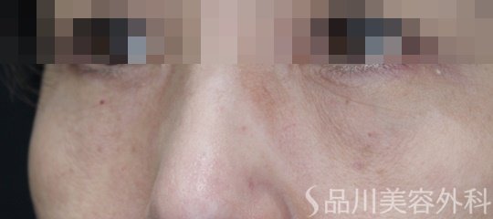 症例NO.70515のAFTER写真