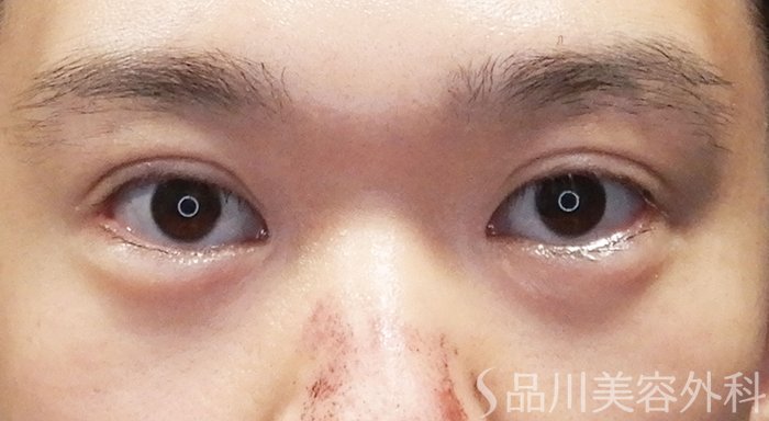 症例NO.71526のAFTER写真