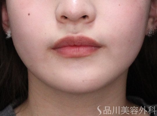 症例NO.73871のAFTER写真