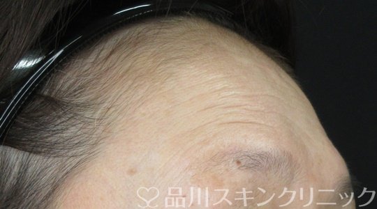 症例NO.69823のBEFORE写真