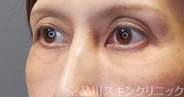 症例NO.67975のAFTER写真