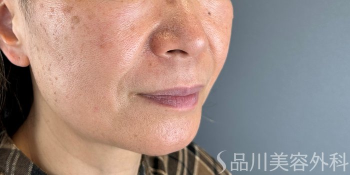 症例NO.70178のBEFORE写真