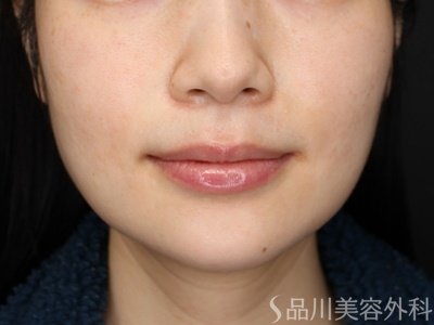 症例NO.69539のBEFORE写真