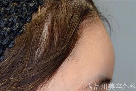 症例NO.50590のBEFORE写真