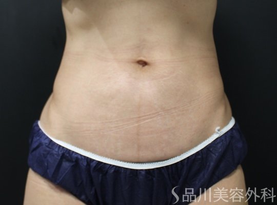 症例NO.75217のAFTER写真
