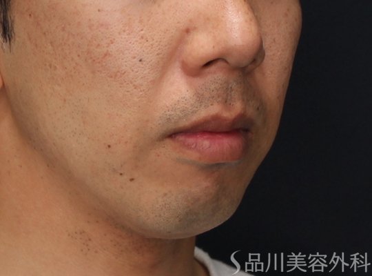 症例NO.71784のBEFORE写真