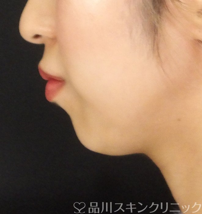 症例NO.67546のAFTER写真