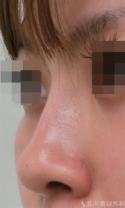 症例NO.26328のBEFORE写真