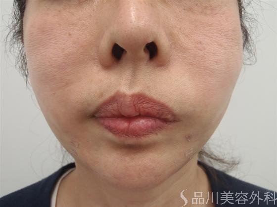 症例NO.17429のAFTER写真