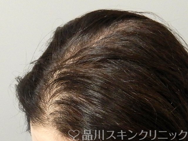 症例NO.69316のAFTER写真