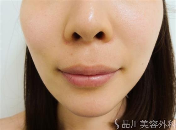 症例NO.31944のAFTER写真